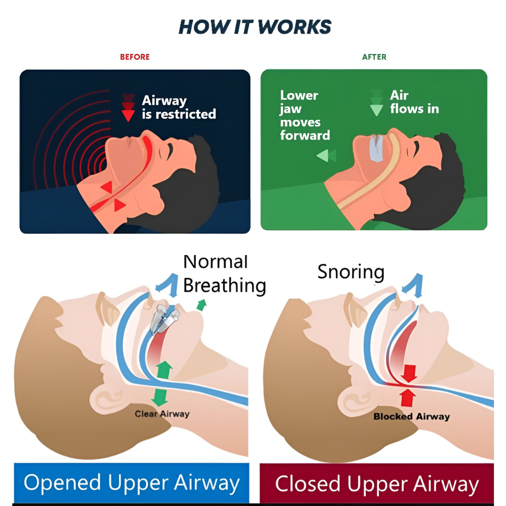 Stop Snoring Mouth Guard